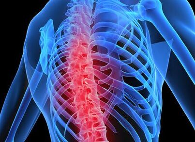 кеуде омыртқасының остеохондрозы