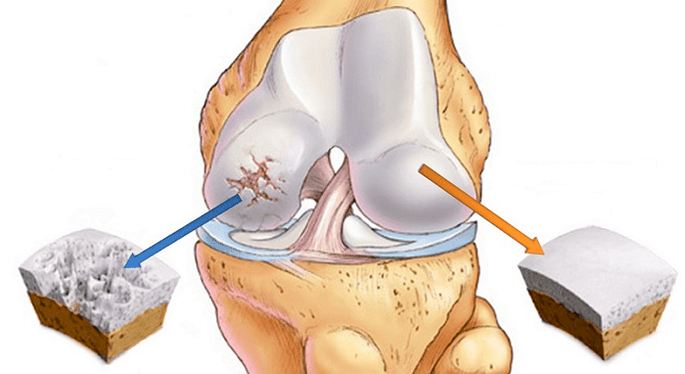 сау шеміршек және артроздан зардап шеккен шеміршек